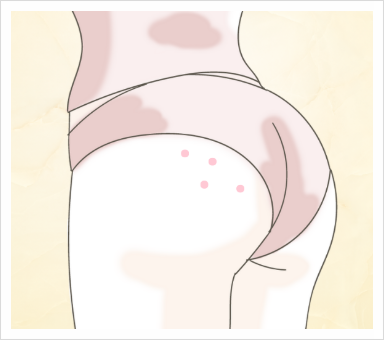 엉덩이 뾰루지 원인과 흉터 관리 방법, 연고 추천