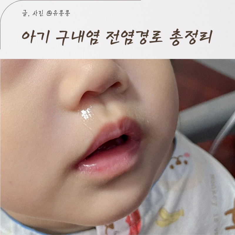 아기 구내염 전염경로 어린이집 등원 언제 가능할까?