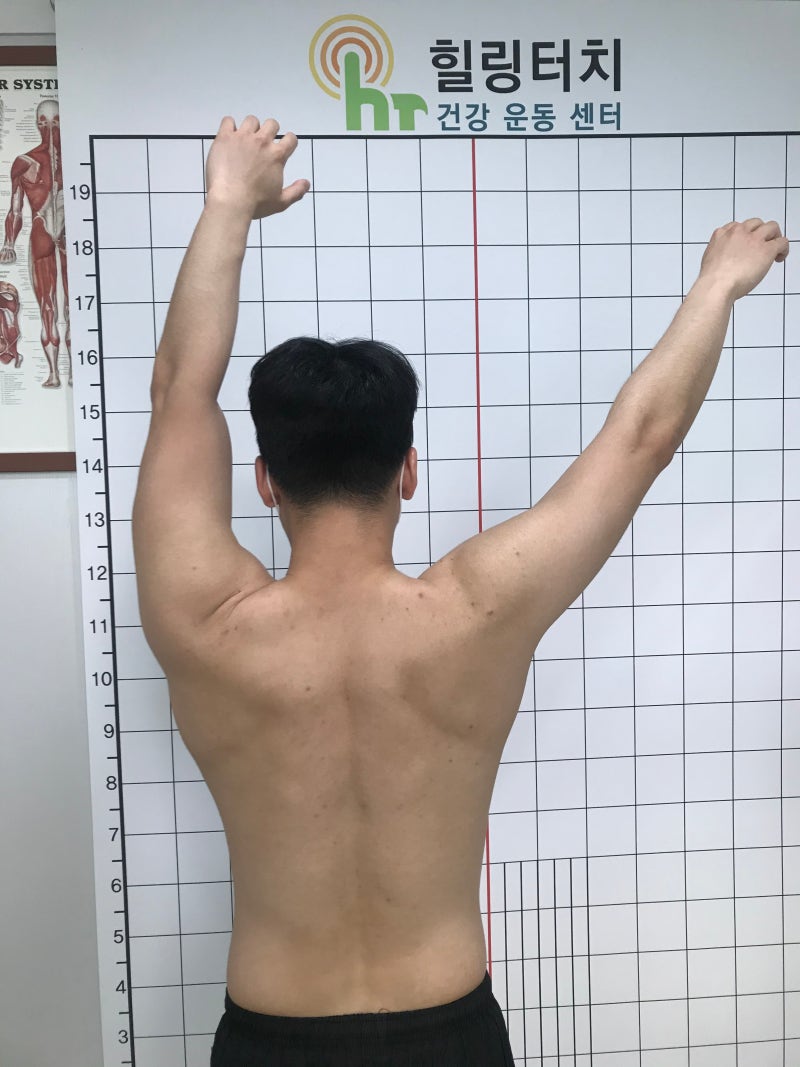 회전근개파열 재활운동: 어깨수술 후 통증 완화 및 가동범위 회복