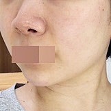 피부탄력시술 종류 중 고우리 스킨부스터 엠보 효과 유지기간은?
