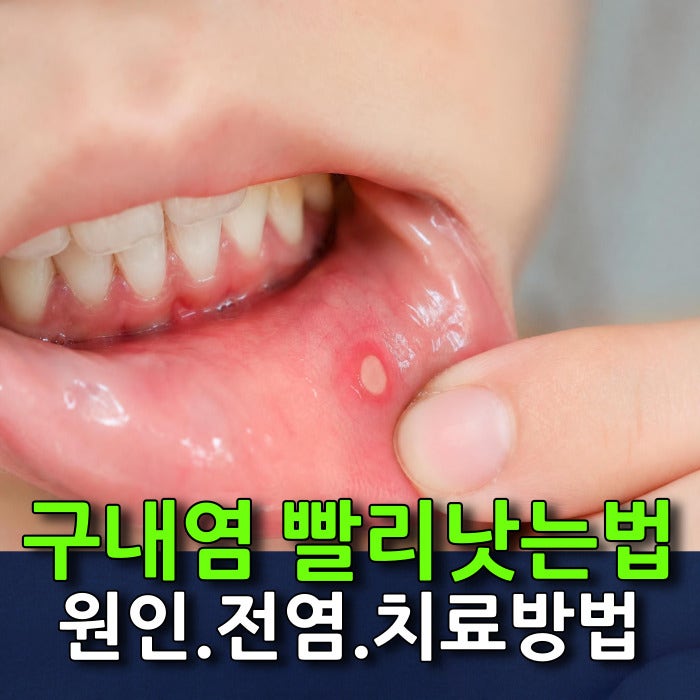 입안 구내염 원인 및 전염될까 걱정될때, 가글 사용법과 구내염 빨리낫는법