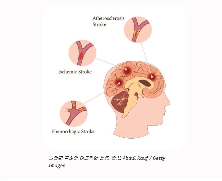 침묵의 살인자 '뇌혈관 질환' 증상, 발생 빈도, 수술