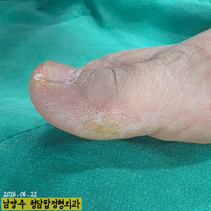 단순 굳은살 인 줄 알았는데, 점점 더 단단하게 튀어나오는 엄지발가락의 돌출