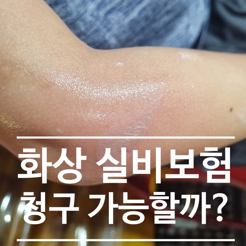 화상 실비보험 청구 후기 | 치료비부터 화상진단비 50만원까지 받은 실제 경험