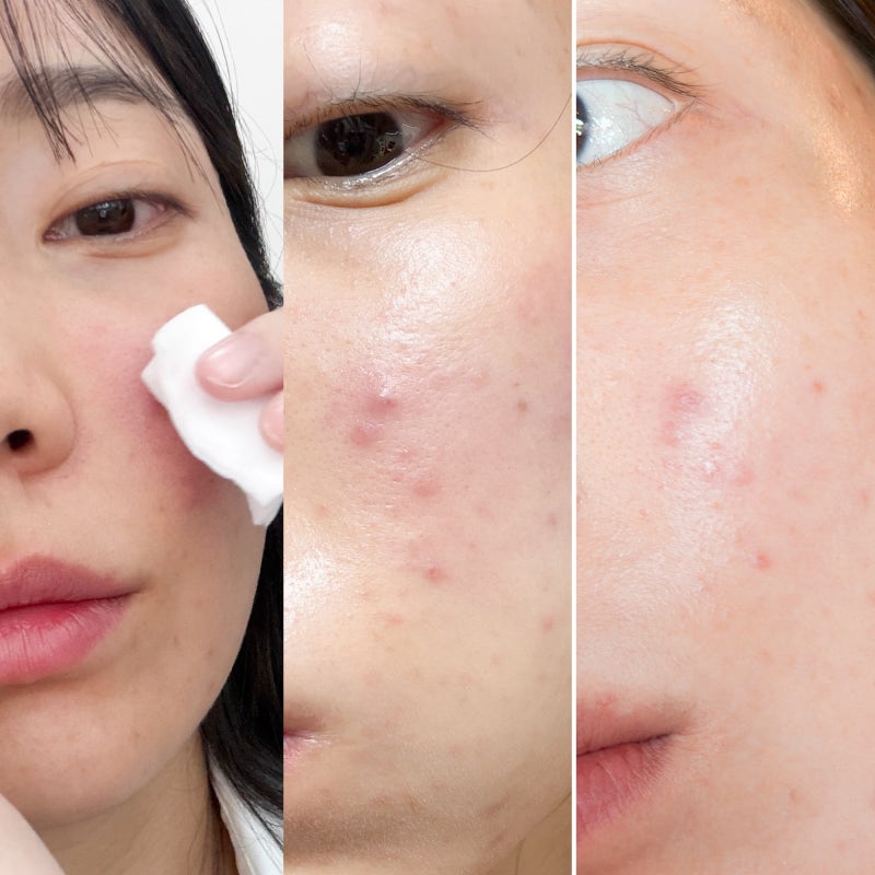 여드름 염증주사 가격 통증 2일차 리얼후기