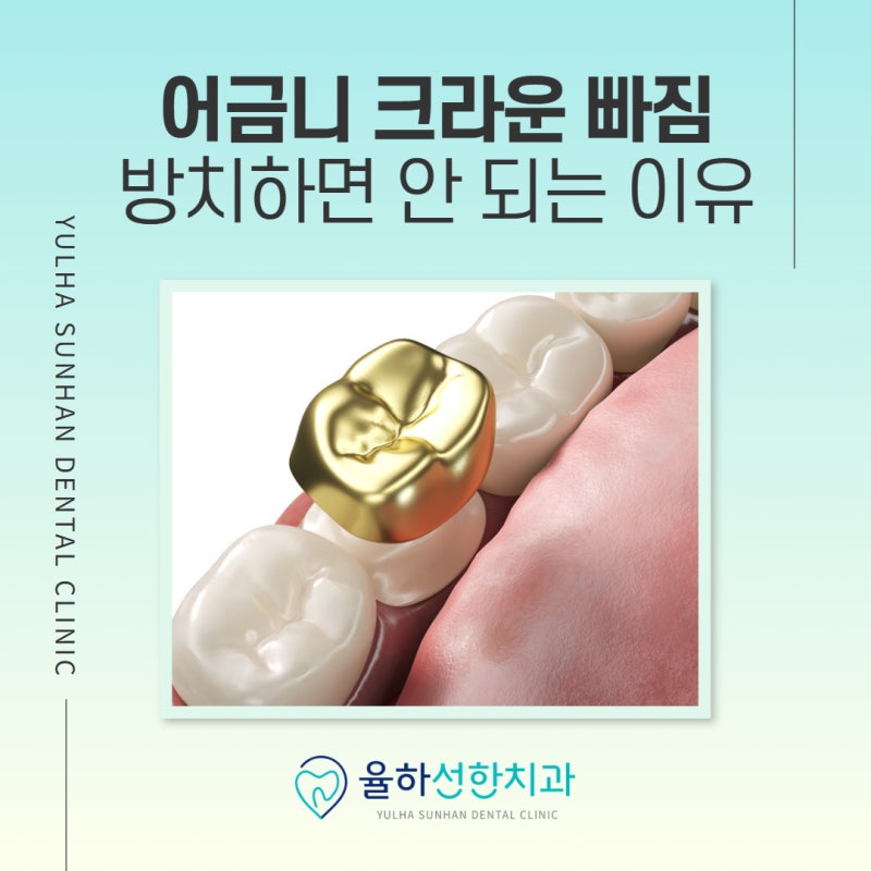 김해 보철치료, 어금니 크라운 빠짐 방치하면 안 되는 이유는?
