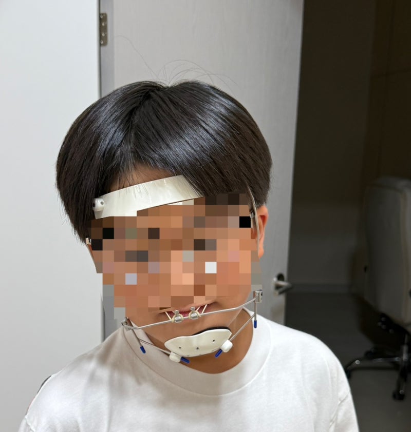 내돈내산 초4 주걱턱,부정교합 교정 시작 | 페이스마스크 가격·기간 솔직후기