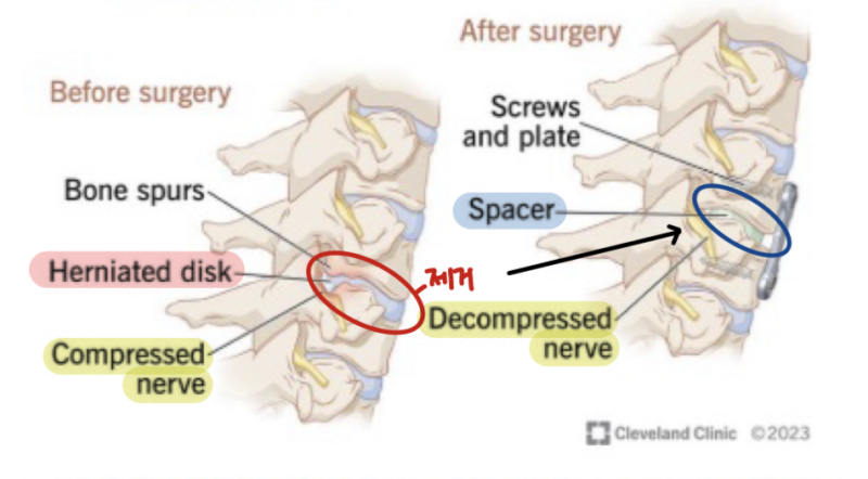 [spine] ACDF( Anterior cervical Discectomy Fusion) 전방 추간판 절제술 및 유합술, 목디스크 수술