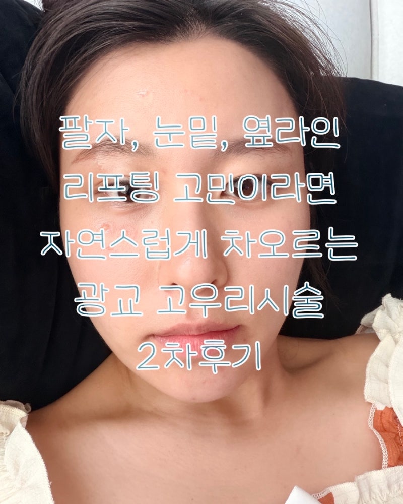 팔자옆라인리프팅 고민이라면 수원광교고우리시술 2차 낋여왔습니다.