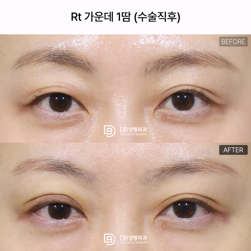 한쪽 쌍꺼풀만 풀렸다면? 짝눈 쌍수 재수술을 결정하기 전에