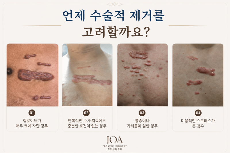 가슴 켈로이드 제거수술, 재발을 줄이기 위한 치료 방법