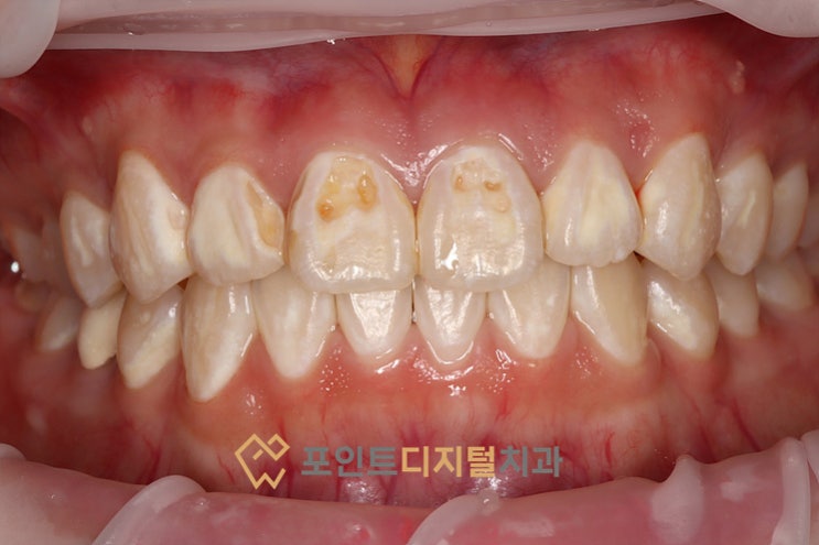 [청소년 심미보철] 15세 여학생의 심한 다발성 우식, PFZ 크라운으로 환한 미소를 되찾다!