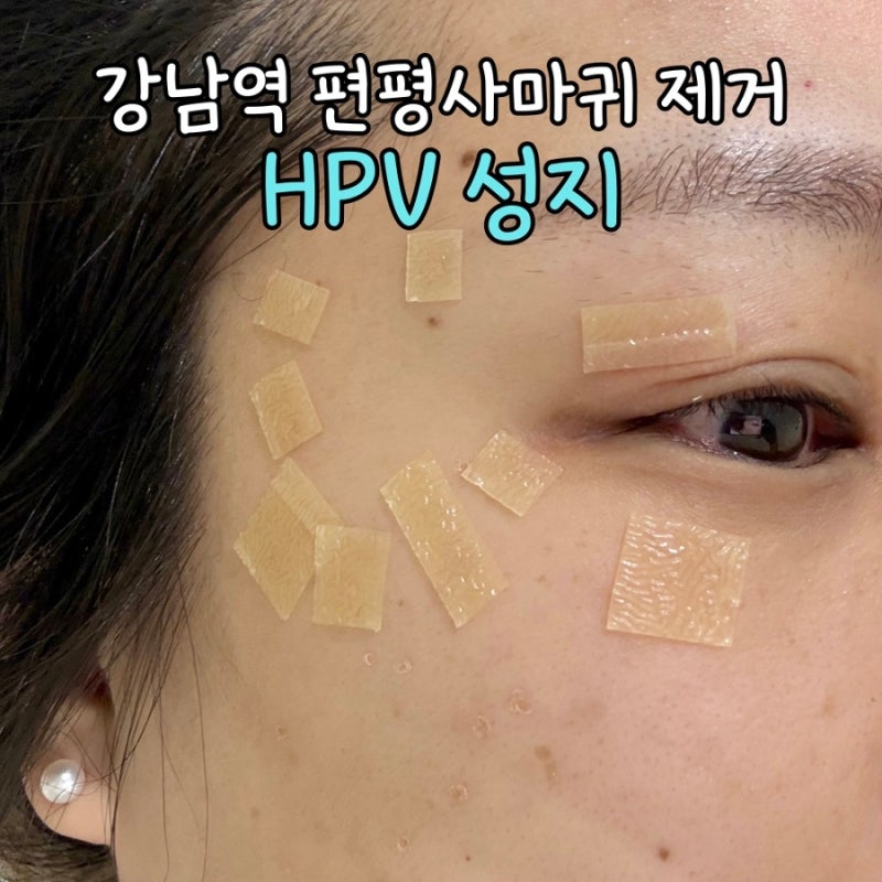 강남역 편평사마귀 무제한 성지에서 제거하기 무료리터치 예신관리 추천