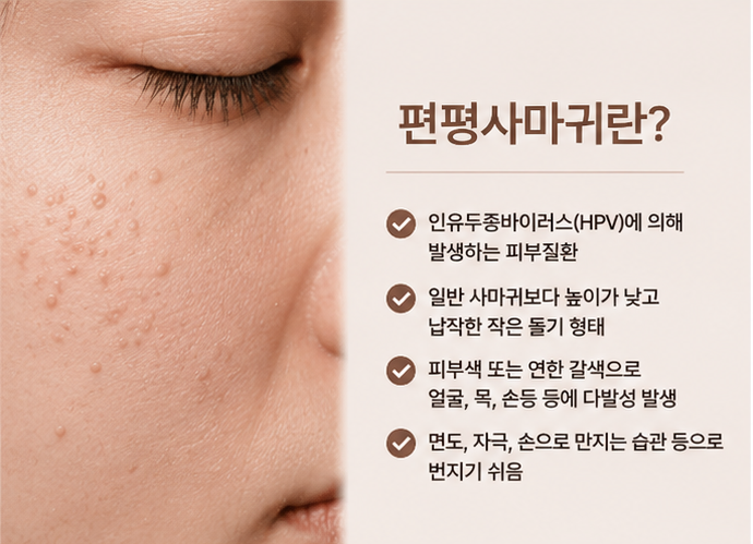 산본편평사마귀, 레이저와 면역치료를 함께 고려해야 하는 이유(산본 오월한의원)