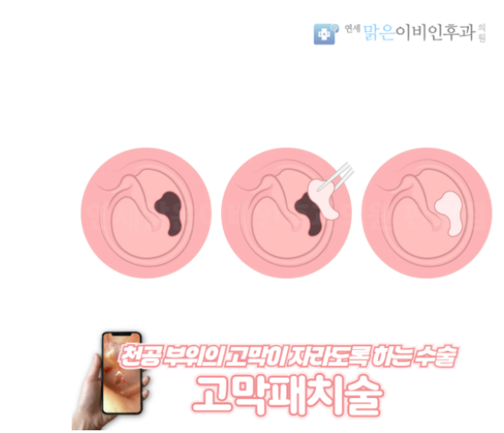 엄마의 수술, 고막천공