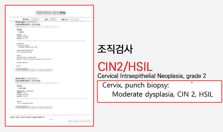 자궁경부 이형성증 2단계(CIN2) 얼마나 심각한 걸까?(증상, 치료)