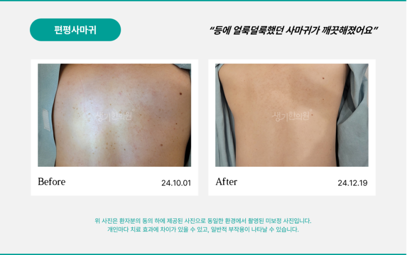 사마귀 연고만으로 없앨 수 있는 사마귀, 따로 있습니다