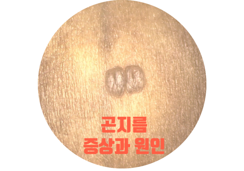 접촉 후 항문과 생식기에 생기는 첨형 콘딜로마 곤지름 (증상, 원인)