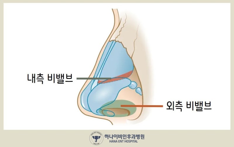 비중격만곡증 수술하면 코도 예뻐질 수 있나요?