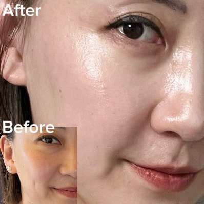 강남 써마지 300샷 리쥬란 2cc 후기 효과 가격 2주 경과 솔직후기