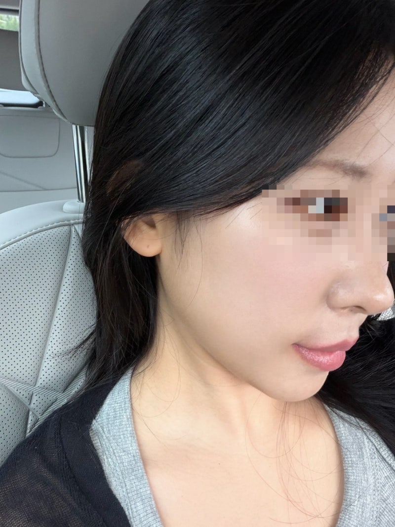 서울 편평사마귀 성지 10만원대 무제한 제거 후기