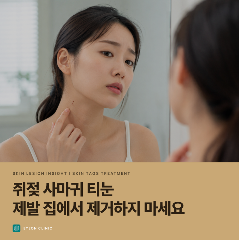 용인 수지 성복역 쥐젖·비립종·사마귀, 크림같은 걸로 떼도 될까요? 피부 돌기의 감별과 안....