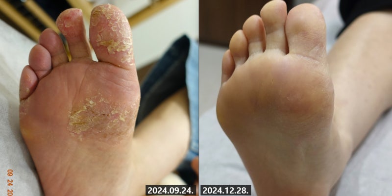 신중동 발 한포진 후기 "병원에서 1년간 스테로이드 연고, 약 먹었는데도 증상이 그대로?" 원....