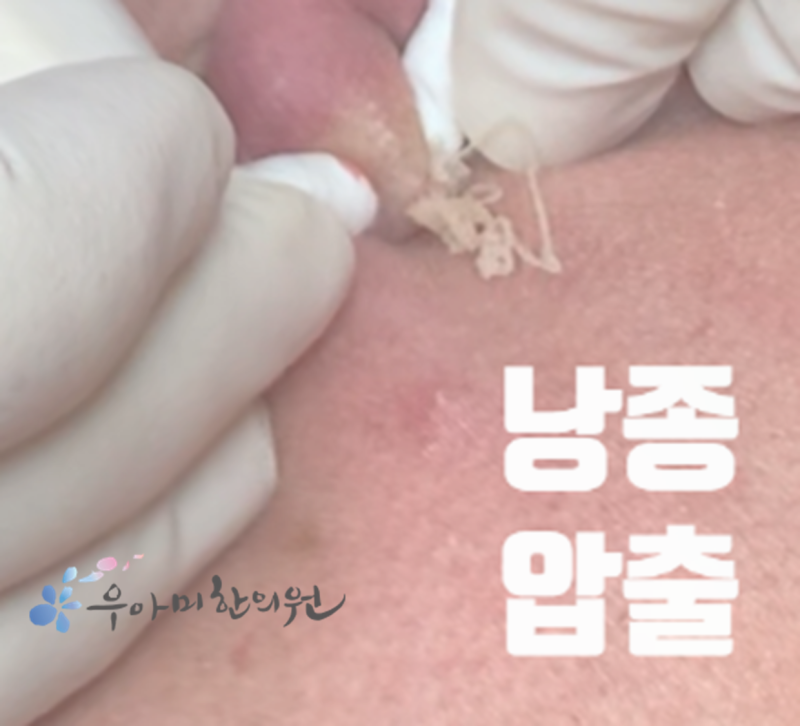 귀뒤 멍울, 피지낭종보다 먼저 지워야 하는 가능성들