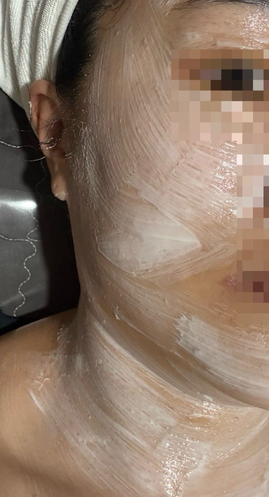 편평사마귀 쥐젖 제거 후기｜여름에 얼굴 목 전체 제거 부천 리샘한의원 솔직 후기