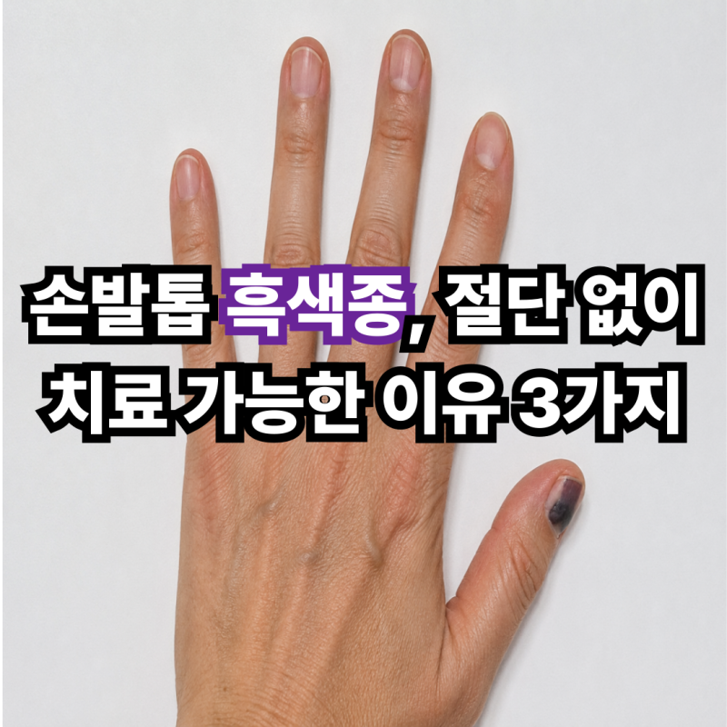 손발톱 흑색종, 절단 없이 치료 가능한 이유 3가지