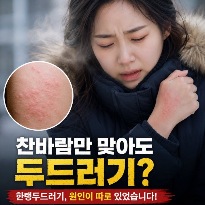 한랭두드러기 원인 찬바람만 맞으면 두드러기가 올라오는 이유