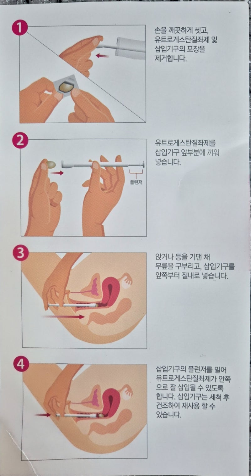 [자궁경부 짧음 조산 위험 극복기] 유트로게스탄 질정 가격 효과와 어플리케이터 사용 꿀팁 (....