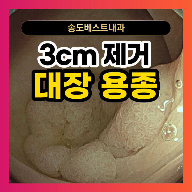 대장 용종 크기 3cm 제거, 조직검사 암 가능성은?