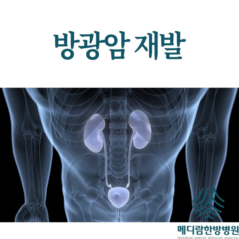 방광암 재발 증상 원인 예방 위한 수술 후 관리는