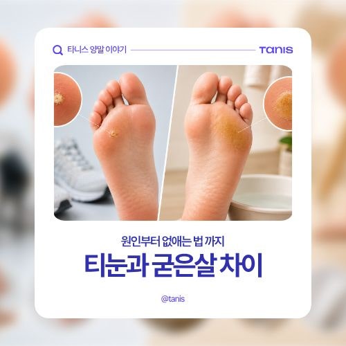 티눈과 굳은살 차이, 원인부터 없애는 법까지