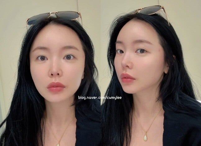 가수 홍진영 인스타 피부과 레이저 시술 고백 나이 프로필 굴욕 없는 민낯 근황 김지민 너무 ....