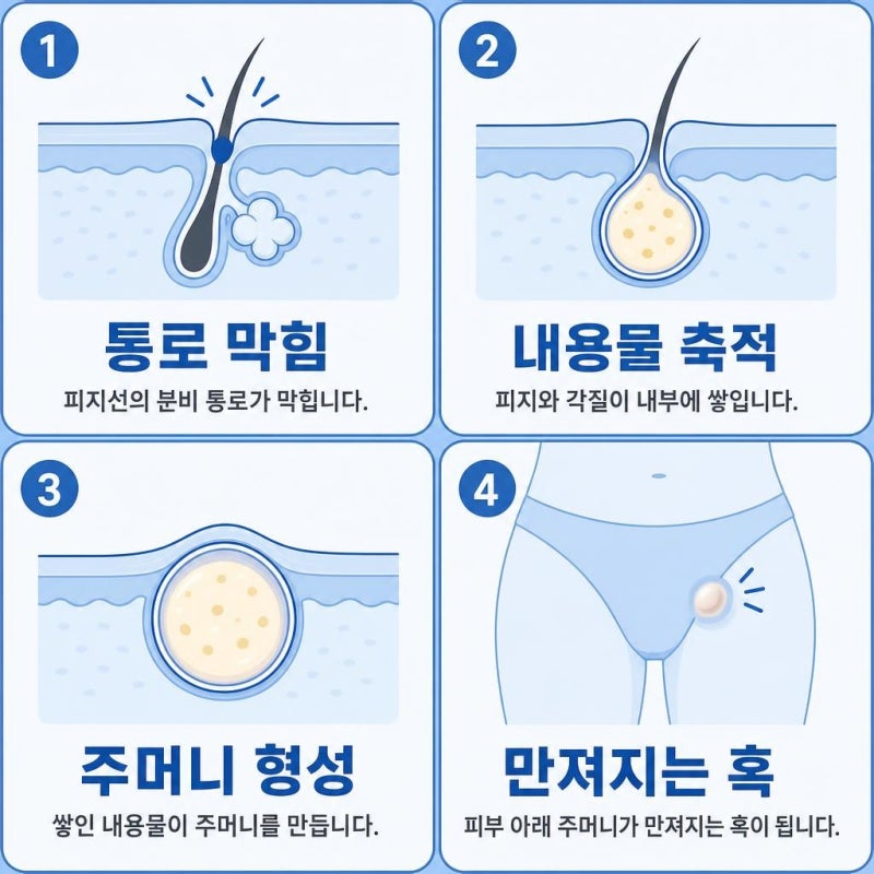 여의사가 알려드리는 사타구니 피지낭종 원인과 제거방법