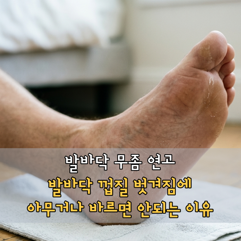 발바닥 무좀 연고, 발바닥 껍질 벗겨짐에 아무거나 바르면 안되는 이유
