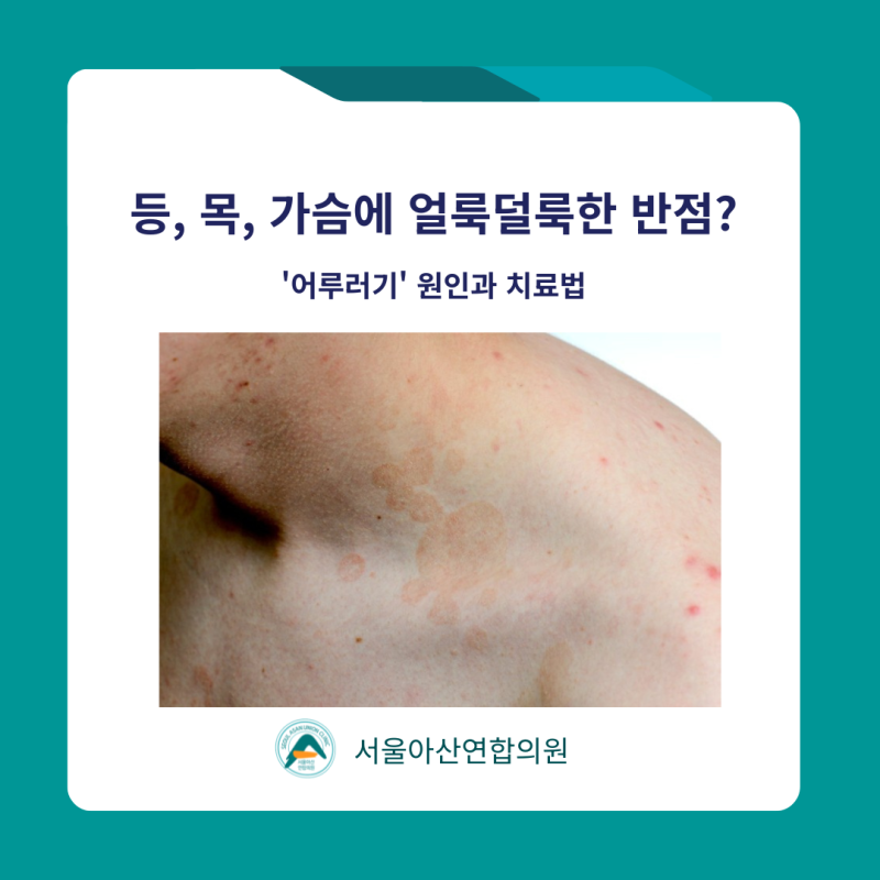 [서울아산연합의원] 송탄 어루러기 치료, 가슴 등 얼룩덜룩한 반점 방치하면 번집니다.