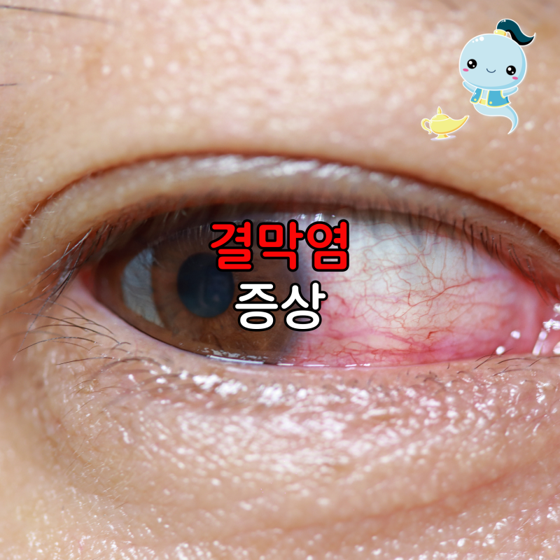 눈에 모래 낀 듯한 결막염 증상, 전염성 유행성과 알레르기성 진짜 쉽게 구별하는 법
