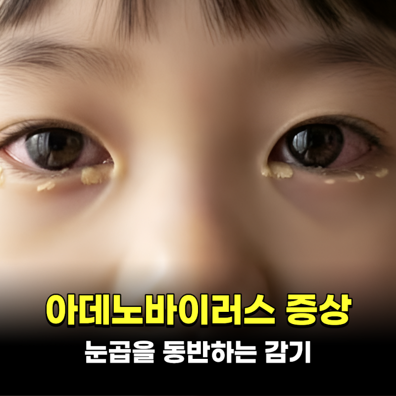 눈곱을 동반하는 감기 아데노바이러스 증상 4가지