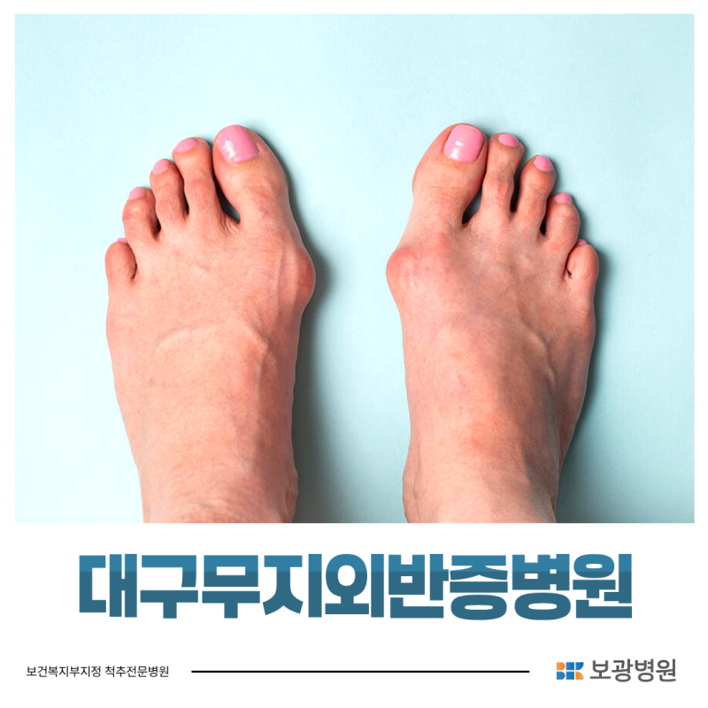 대구무지외반증병원, 수술이 필요한 경우는 언제일까?