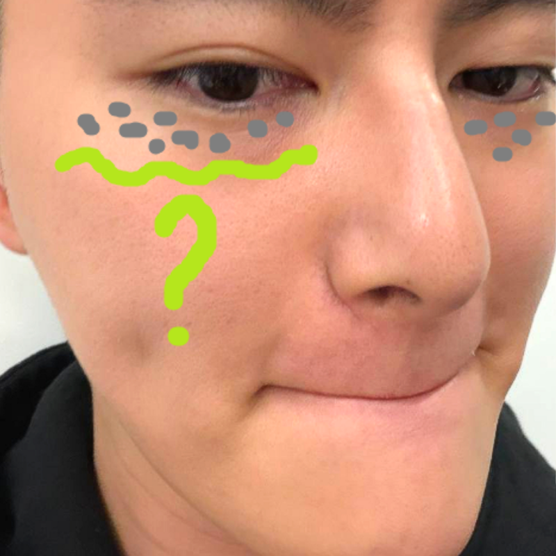 천안한관종 눈가에 오돌토돌하게 올라오는 이유와 케어방법