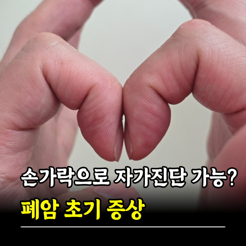 "손가락으로 자가진단이 가능하다고?" 폐암초기증상