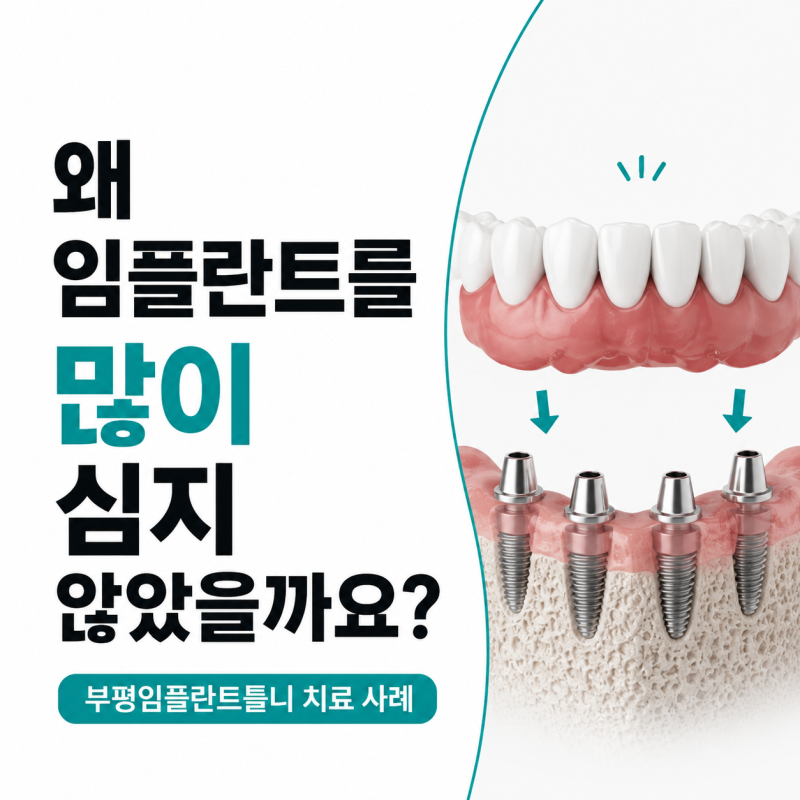 부평임플란트틀니, 왜 임플란트를 많이 심지 않았을까요?