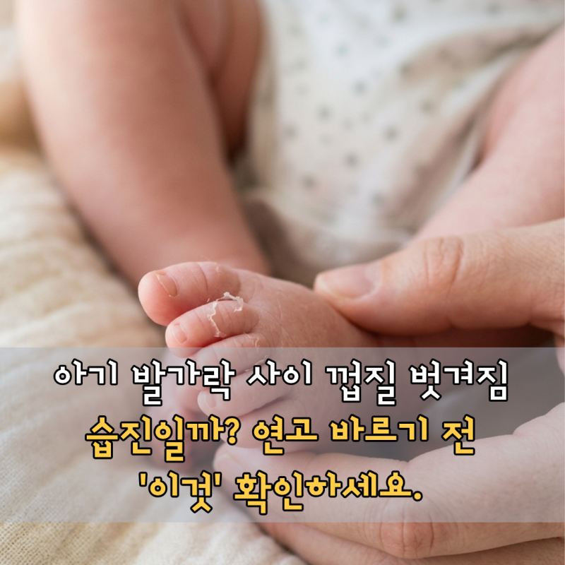 아기 발가락 사이 껍질 벗겨짐, 습진일까? 연고 바르기 전 '이것' 확인하세요.