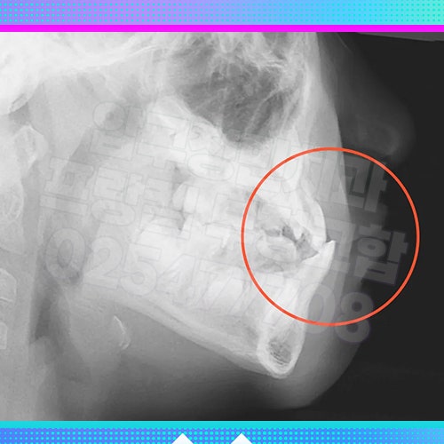 어린이 부정교합 치아 교정기 기간 : 차이가 나는 이유?