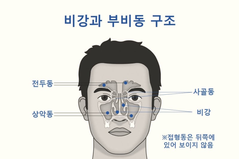 "내 콧물은 비염일까, 축농증일까?" 딱 3가지만 확인해 보세요