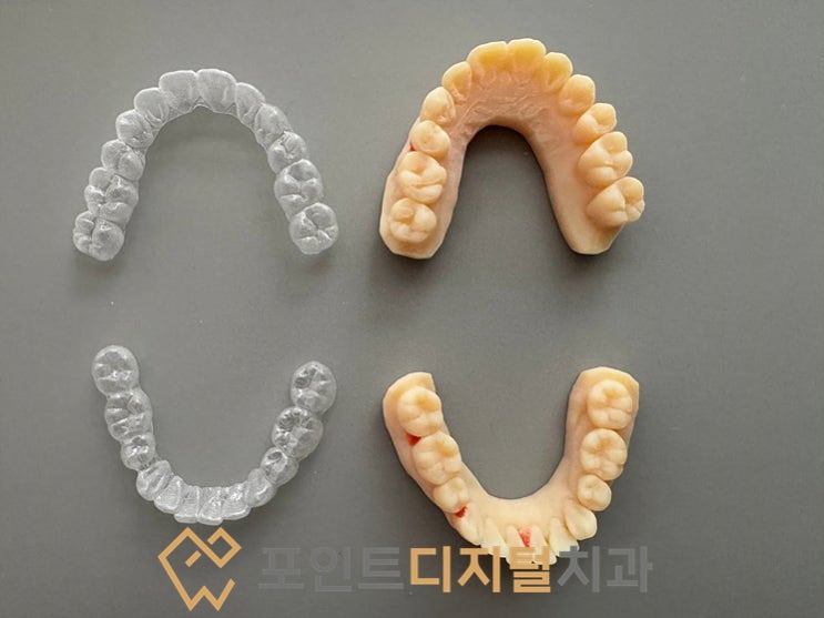 [탕정치과] 50대 남성 자가미백 10일의 변화 : 디지털 스캔으로 제작하는 오스템 뷰티스홈 리얼 후기 / 천안 아산