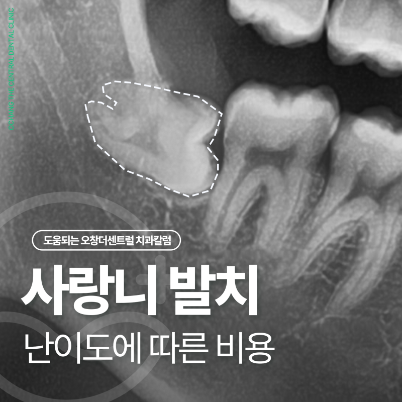 매복 사랑니 발치 비용, 난이도에 따라 달라지는 이유?